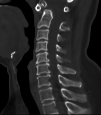 Os odontoideum associated with a retro-odontoid cyst treated with posterior C1–C3 fixation: A case report and literature review